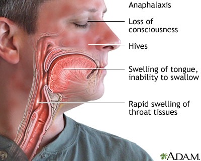 allergy reaction throat ADAM
